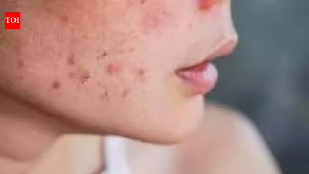 Why your acne scars won’t go away — science finds the real reason 1 1774252613 photo.jpg