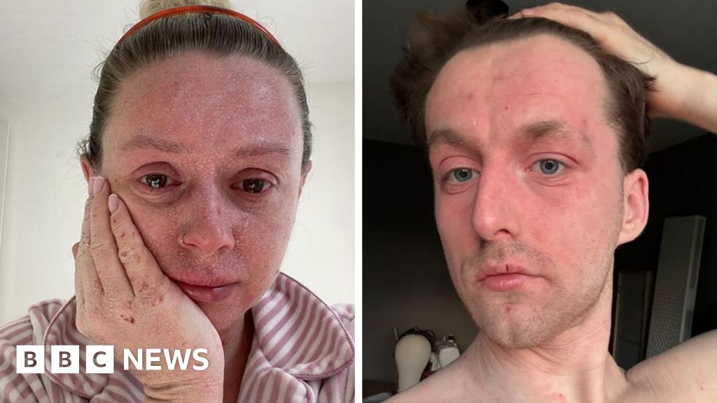 'Our skin is falling off and no-one can tell us why ' 1 692a8340 2a9a 11f1 934f 036468834728.jpg